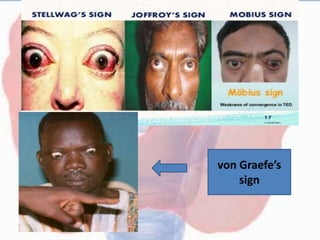 von Graefe’s
sign
 