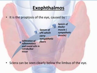 Exophthalmos
• It is the proptosis of the eye, caused by :
• Sclera can be seen clearly below the limbus of the eye.
Infiltration of
inflammatory
and round cells in
retrobulbar
tissue
Spasm of
LPS which
carry
sympathetic
fibers
Spasm of
Muller
muscle (
sympathetic
muscle)
 
