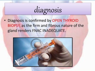 diagnosis
• Diagnosis is confirmed by OPEN THYROID
BIOPSY, as the firm and fibrous nature of the
gland renders FNAC INADEQUATE.
 