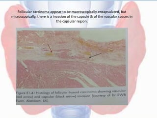Follicular carcinoma appear to be macroscopically encapsulated, but
microscopically, there is a invasion of the capsule & of the vascular spaces in
the capsular region.
 