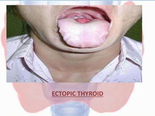 ECTOPIC THYROID
 