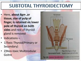 • Here, about 8gm ,or
tissue, size of pulp of
finger, is retained on lower
pole of thyroid on both
sides and rest of thyroid
gland is removed
• Indications –
• 1)Toxic Thyroid(Primary or
Secondary)
• 2)Non-toxic Multinodular
Goitre
 