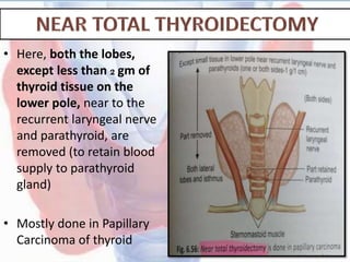 • Here, both the lobes,
except less than 2 gm of
thyroid tissue on the
lower pole, near to the
recurrent laryngeal nerve
and parathyroid, are
removed (to retain blood
supply to parathyroid
gland)
• Mostly done in Papillary
Carcinoma of thyroid
 
