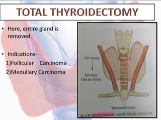 • Here, entire gland is
removed.
• Indications-
1)Follicular Carcinoma
2)Medullary Carcinoma
 