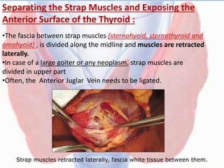 Separating the Strap Muscles and Exposing the
Anterior Surface of the Thyroid :
Strap muscles retracted laterally, fascia white tissue between them.
•The fascia between strap muscles (sternohyoid, sternothyroid and
omohyoid) , is divided along the midline and muscles are retracted
laterally.
•In case of a large goiter or any neoplasm, strap muscles are
divided in upper part
•Often, the Anterior Juglar Vein needs to be ligated.
 