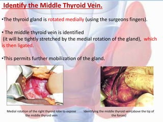 Identify the Middle Thyroid Vein.
•The thyroid gland is rotated medially (using the surgeons fingers).
• The middle thyroid vein is identified
(it will be tightly stretched by the medial rotation of the gland), which
is then ligated.
•This permits further mobilization of the gland.
Medial rotation of the right thyroid lobe to expose
the middle thyroid vein
Identifying the middle thyroid vein(above the tip of
the forces)
 
