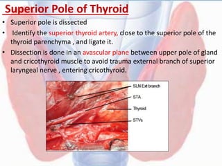 Superior Pole of Thyroid
• Superior pole is dissected
• Identify the superior thyroid artery, close to the superior pole of the
thyroid parenchyma , and ligate it.
• Dissection is done in an avascular plane between upper pole of gland
and cricothyroid muscle to avoid trauma external branch of superior
laryngeal nerve , entering cricothyroid.
 