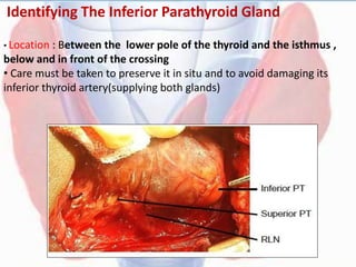 Identifying The Inferior Parathyroid Gland
• Location : Between the lower pole of the thyroid and the isthmus ,
below and in front of the crossing
• Care must be taken to preserve it in situ and to avoid damaging its
inferior thyroid artery(supplying both glands)
 