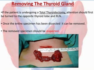 Removing The Thyroid Gland
•If the patient is undergoing a Total Thyroidectomy, attention should first
be turned to the opposite thyroid lobe and RLN.
• Once the entire specimen has been dissected it can be removed.
• The removed specimen should be inspected.
 