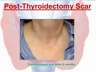 Post-Thyroidectomy Scar
Thyroidectomy scar after 6 months.
 