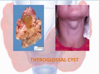 THYROGLOSSAL CYST
 