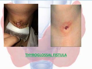 THYROGLOSSAL FISTULA
 