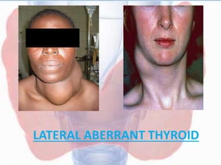 LATERAL ABERRANT THYROID
 