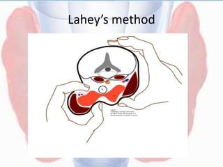 Lahey’s method
 