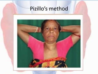 Pizillo’s method
 