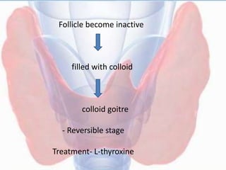 Follicle become inactive
filled with colloid
colloid goitre
- Reversible stage
Treatment- L-thyroxine
 