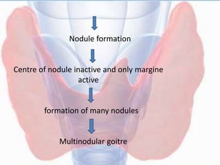 Nodule formation
Centre of nodule inactive and only margine
active
formation of many nodules
Multinodular goitre
 