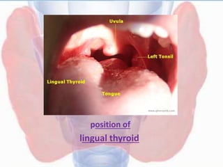 DIFFERENTIAL DIAGNOSIS FOR LINGUAL
THYROID
• Carcinoma of posterior third of tongue
• Angiofibroma
• Sarcoma
• Hypertrophi...