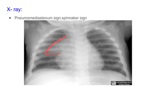 Spinacker Sign Surgery -osephageal injuries by final yearstudent | PPTX