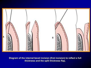 Oval Incision General Principles of Surgical Techniques for Periodontal Regeneration ...