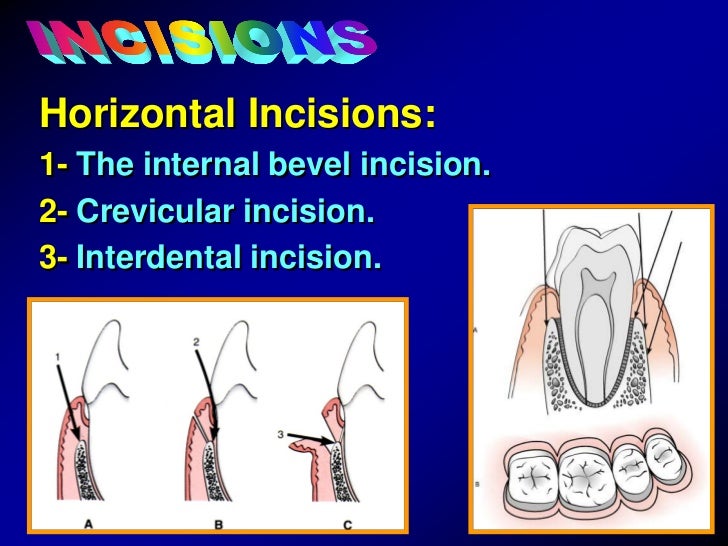General Principles of Surgical Techniques for Periodontal Regeneration