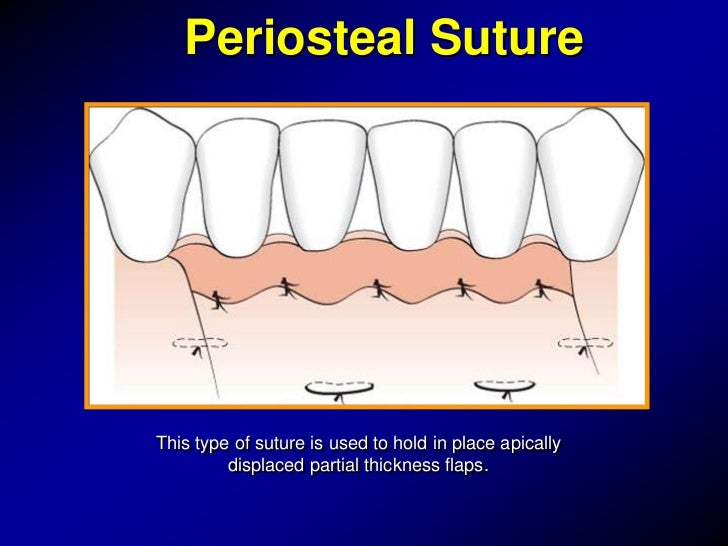 General Principles of Surgical Techniques for Periodontal Regeneration