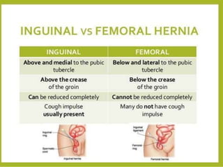 Femoral Hernia: A case presentation 