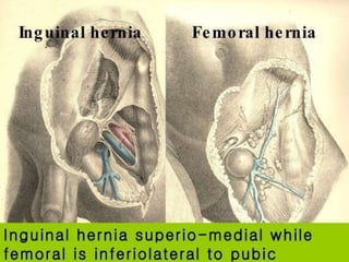 Femoral Hernia: A case presentation 