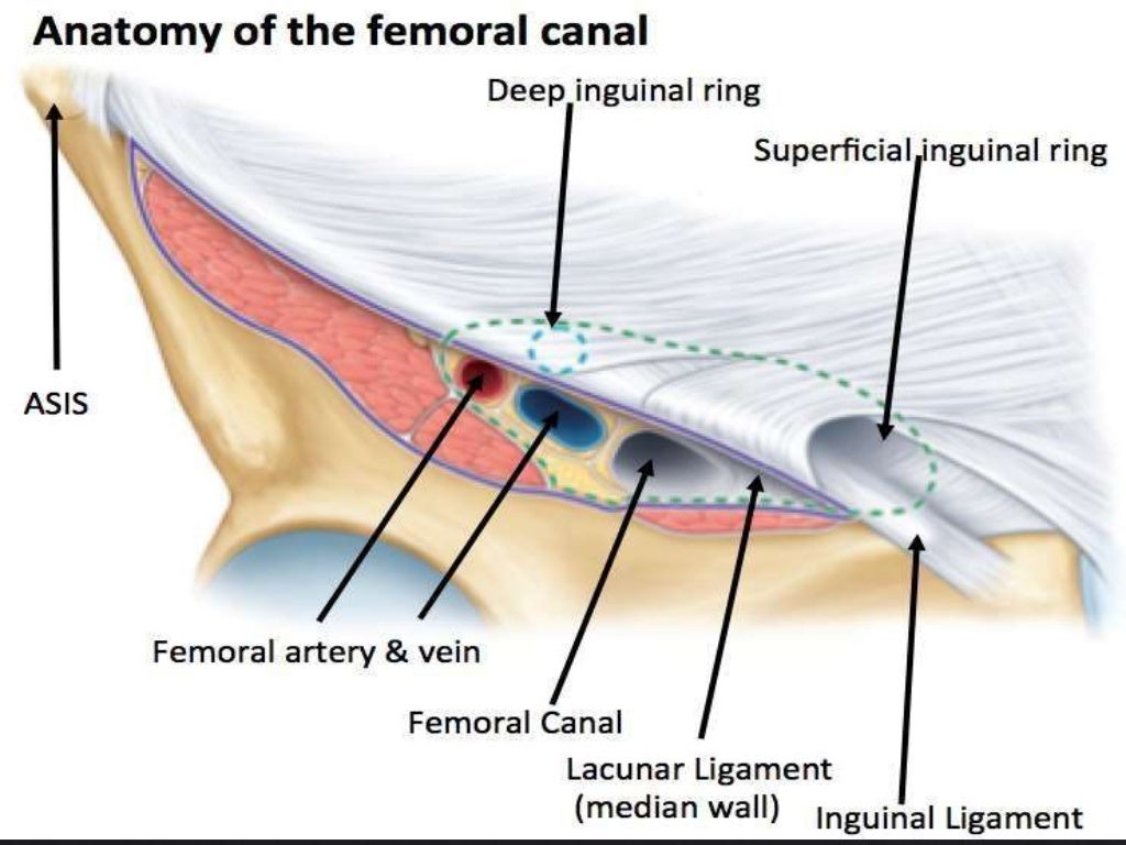 Femoral Hernia A Case Presentation