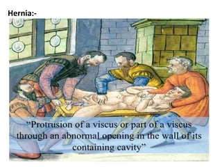 Hernia:-
 