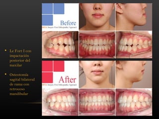 19
 Le Fort I con
impactación
posterior del
maxilar
 Osteotomía
sagital bilateral
de rama con
retroceso
mandibular
 