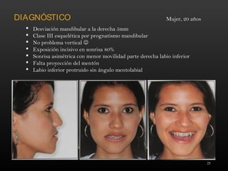25
DIAGNÓSTICO
 Desviación mandibular a la derecha 5mm
 Clase III esquelética por prognatismo mandibular
 No problema vertical 
 Exposición incisivo en sonrisa 80%
 Sonrisa asimétrica con menor movilidad parte derecha labio inferior
 Falta proyección del mentón
 Labio inferior protruido sin ángulo mentolabial
Mujer, 20 años
 