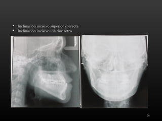 26
 Inclinación incisivo superior correcta
 Inclinación incisivo inferior retro
 