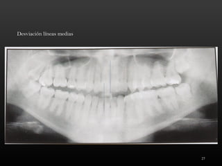 27
Desviación líneas medias
 