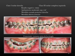 28
Cementado 1semana antes de la cirugía
Clase I molar derecha Clase III molar completa izquierda
Resalte negativo -4mm
Apiñamiento moderado sup e inf
Mordida cruzada posterior derecha
Mordida abierta anterior
 