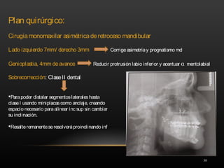 30
Plan quirúrgico:
Cirugíamonomaxilar asimétricaderetroceso mandibular
Lado izquierdo 7mm/ derecho 3mm Corrigeasimetríay prognatismo md
Genioplastia, 4mm deavance Reducir protrusión labio inferior y acentuar α mentolabial
Sobrecorrección: ClaseII dental
Parapoder distalar segmentoslateraleshasta
claseI usando miniplacascomo anclaje, creando
espacio necesario paraalinear inc sup sin cambiar
su inclinación.
Resalteremanenteseresolveráproinclinando inf
 