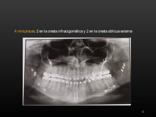32
4 miniplacas: 2 en lacrestainfracigomáticay 2 en lacrestaoblicuaexterna
 