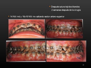 33
 Despuéssuturatejidosblandos:
2 semanasdespuésdelacirugía
 14 Niti md y 16x16 NIti mx saltando sector antero-superior
 