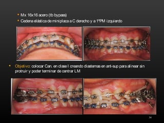 34
 Mx 16x16 acero (tb bypass)
 CedenaelásticademiniplacaaC derecho y a1ºPM izquierdo
 Objetivo: colocar Can. en claseI creando diastemasen ant-sup paraalinear sin
protruir y poder terminar decentrar LM
 