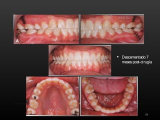 35
 Descementado 7
mesespost-cirugía
 