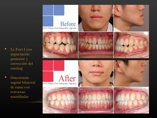 38
 Le Fort I con
impactación
posterior y
corrección del
canting
 Osteotomía
sagital bilateral
de rama con
retroceso
mandibular
 