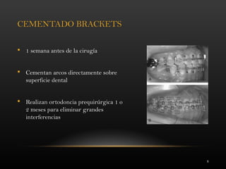 8
CEMENTADO BRACKETS
 1 semana antes de la cirugía
 Cementan arcos directamente sobre
superficie dental
 Realizan ortodoncia prequirúrgica 1 o
2 meses para eliminar grandes
interferencias
 