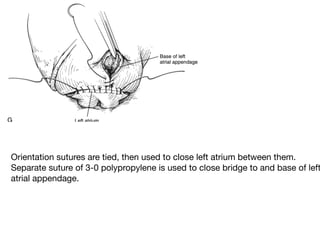 Surgery for atrial fibrillation abhijit presentation | PDF