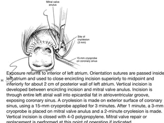 Surgery for atrial fibrillation abhijit presentation | PDF