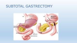 SUBTOTAL GASTRECTOMY
 
