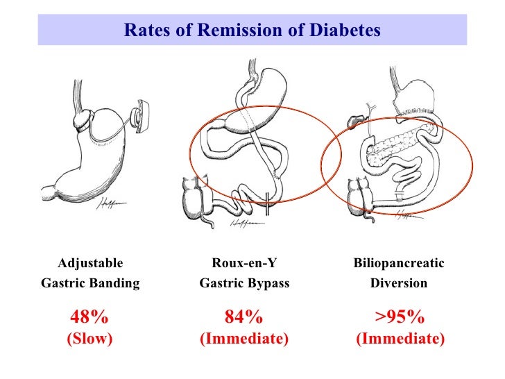 Surgery for Obesity Duodeno-Jejunal Bypass forType 2 ...