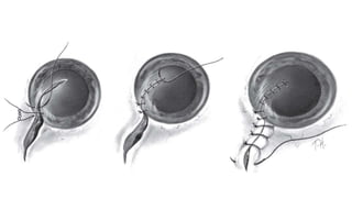 Surgery for ocular trauma | PPTX