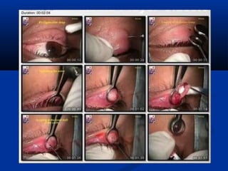 Surgery for Optometry