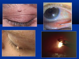 Surgery for Optometry