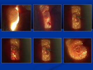 Surgery for Optometry